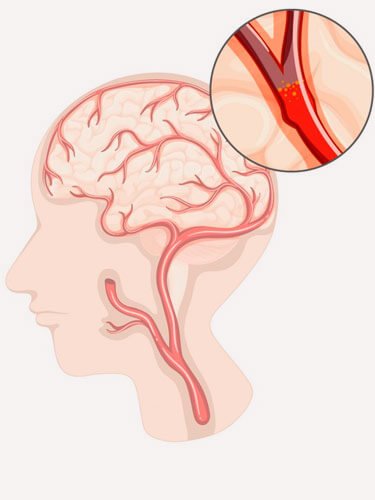 acidente-vascular-cerebral-isquemico