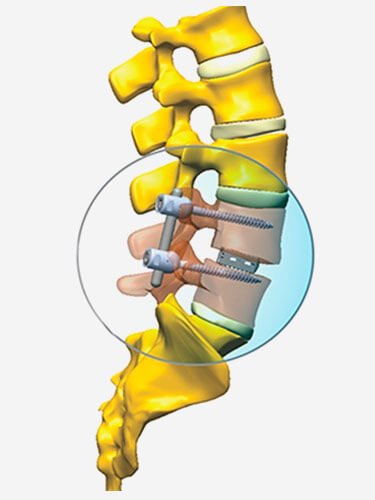cirurgia-de-artrodese-dr-jose-alberto