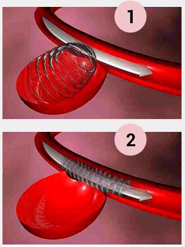 embolizacao-de-tumor-cerebral-no-rio-de-janeiro