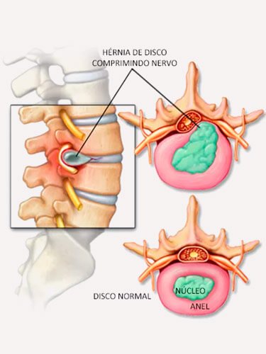 hernia-de-disco-lombar-dr-jose-alberto