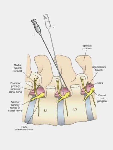 infiltracao-foraminal-dr-jose-alberto
