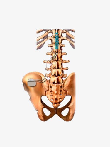 neuroestimulador-tratamento-da-dor-cronica