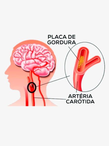 obstrucao-das-carotidas