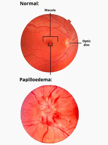 tratamento-pseudotumor-cerebral