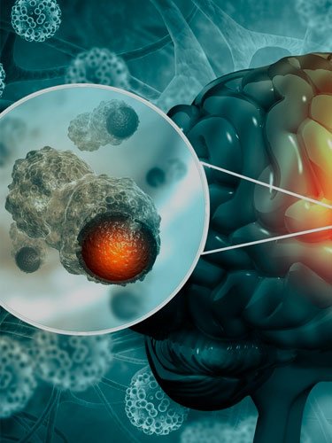 tumores-cerebrais-dr-jose-alberto