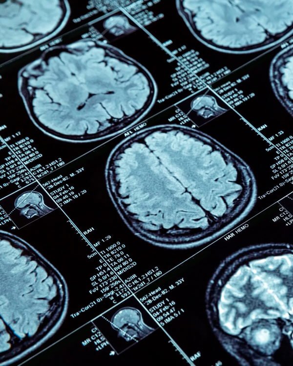 Tumores cerebrais e principais sintomas - Dr José Alberto